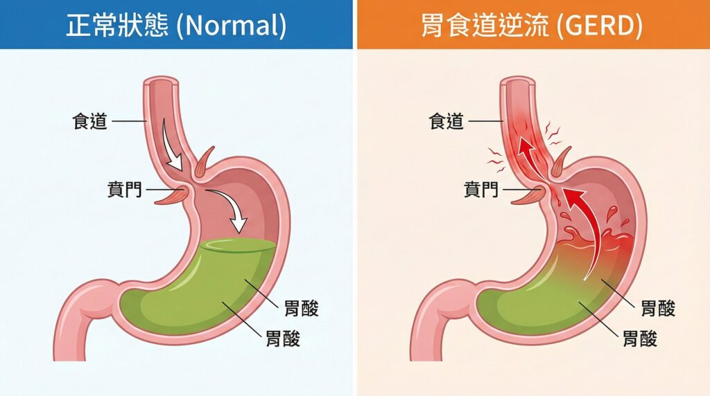口乾與逆流關係圖