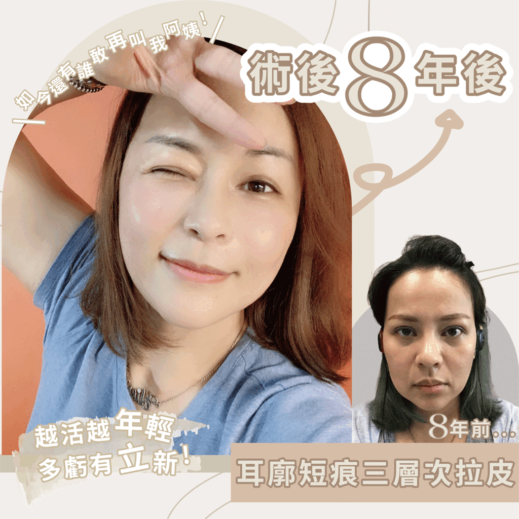 內視鏡拉皮優點