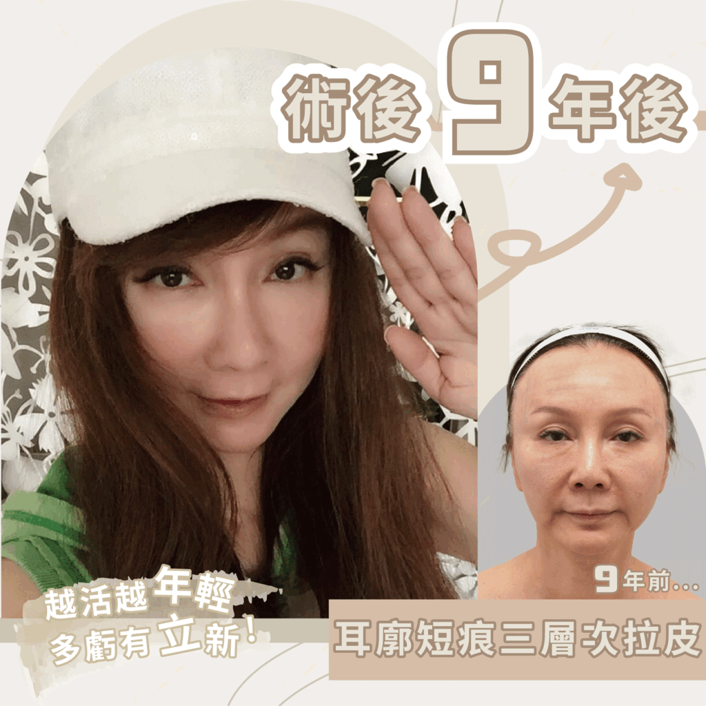 萊恩醫美拉皮服務