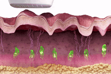 治療過程示意圖