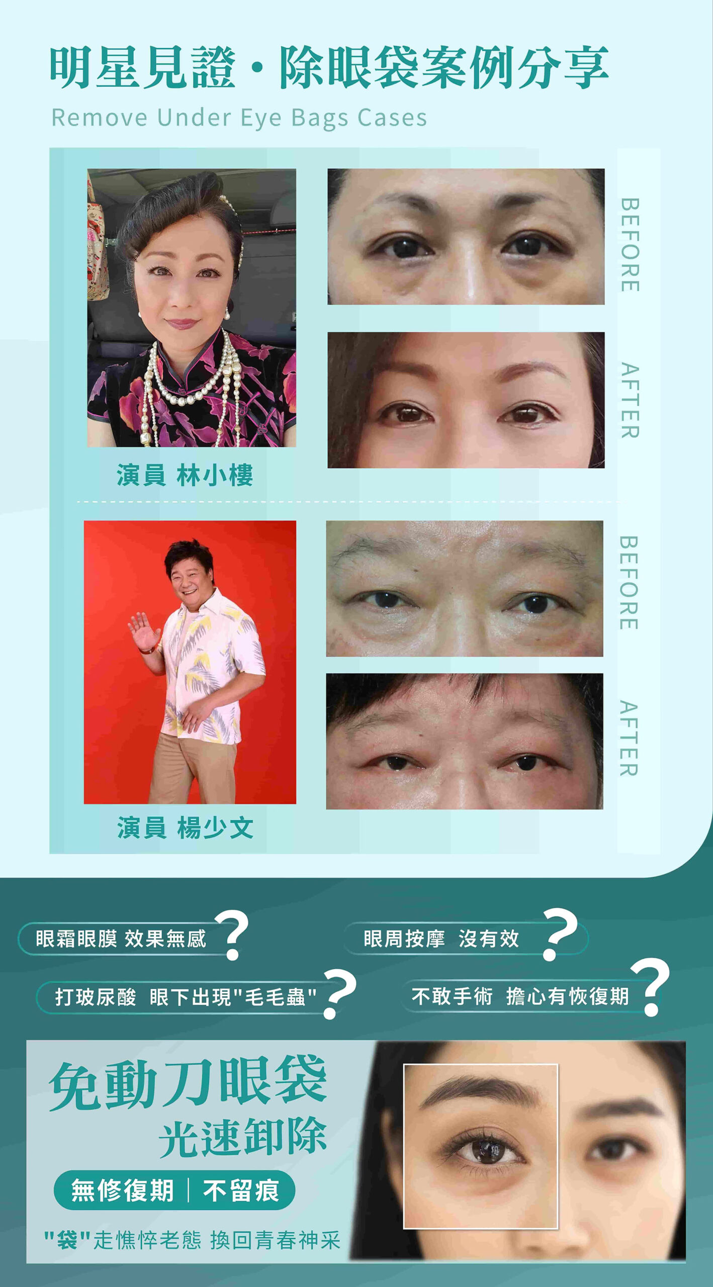 眼袋年輕化 療程說明