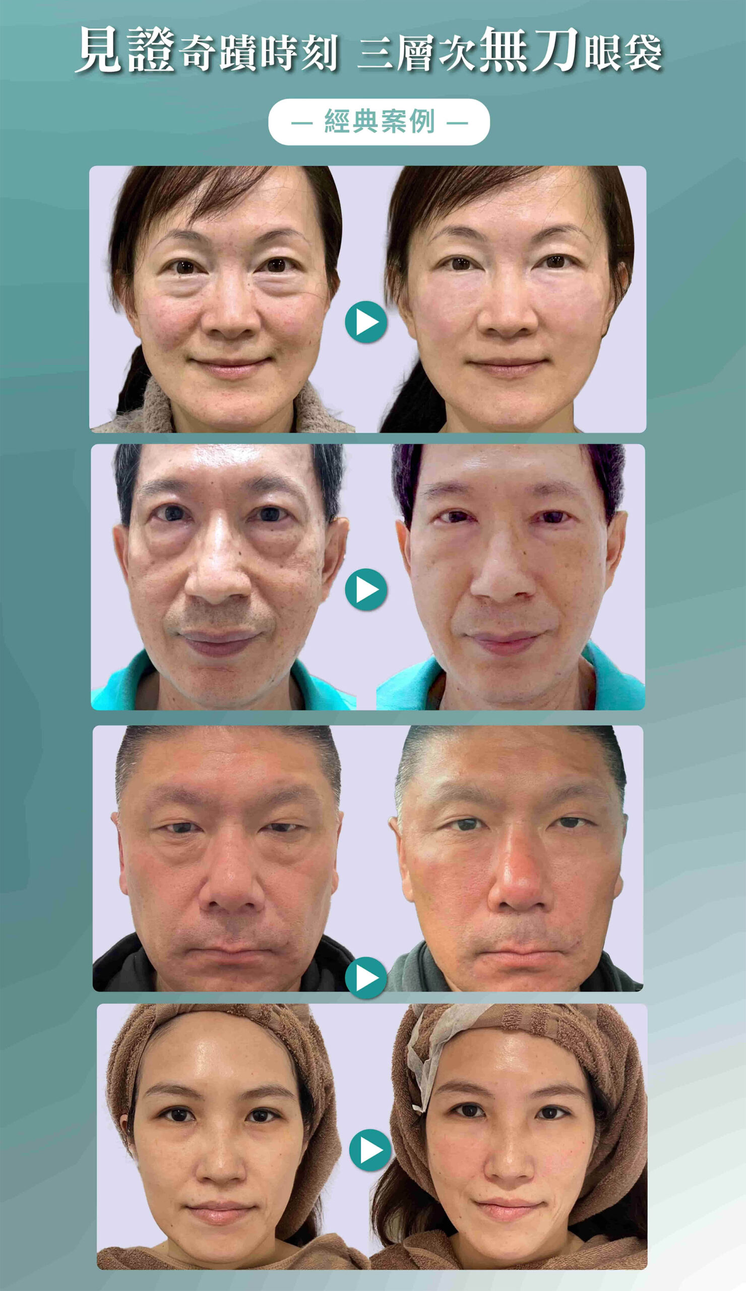 眼袋年輕化 手術後照