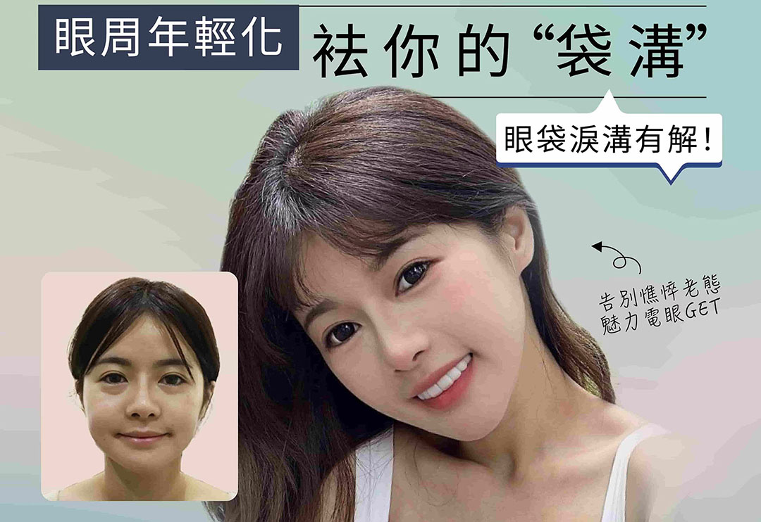 眼袋淚溝年輕化術前術後對比廣告圖
