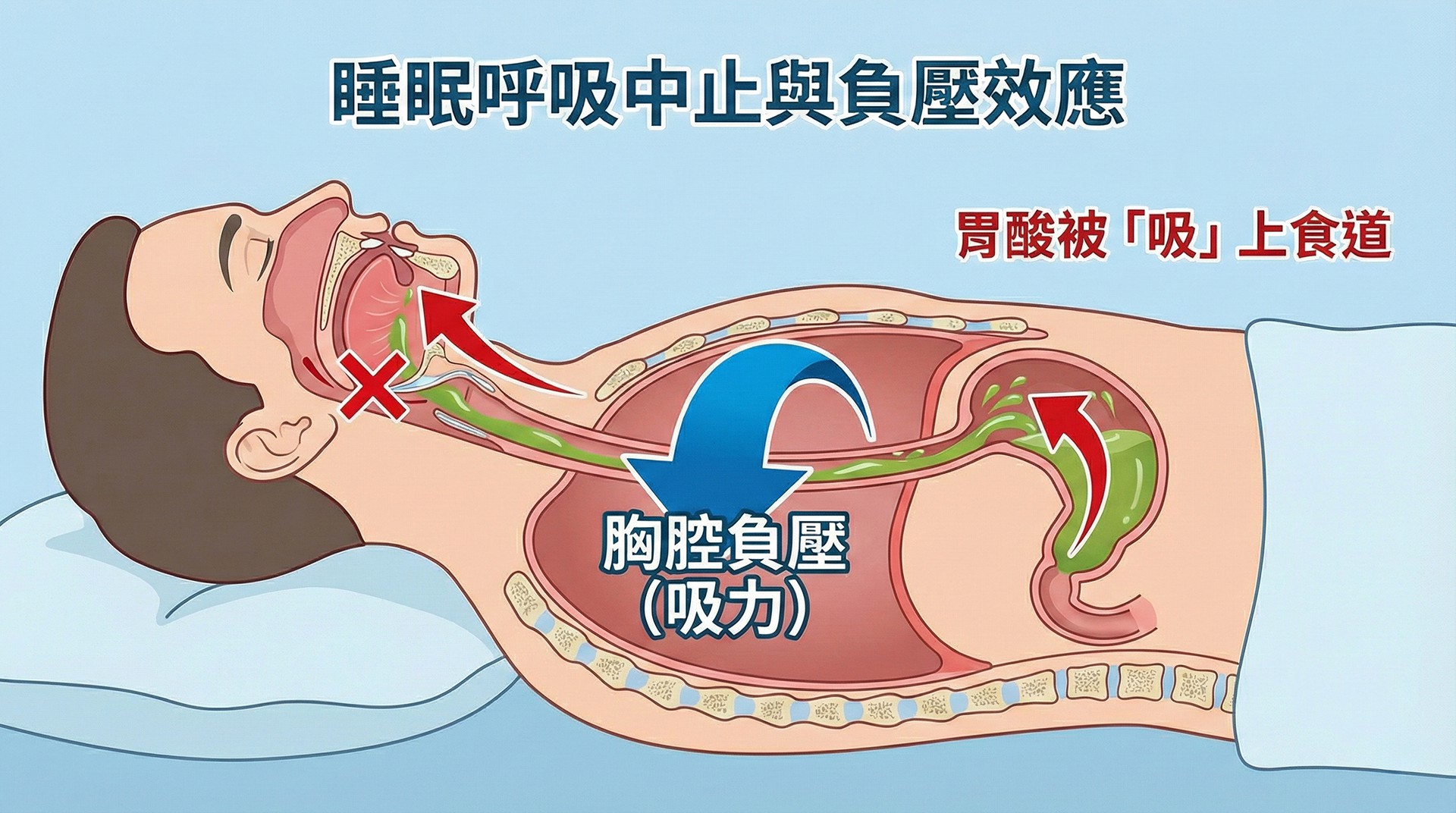OSA負壓效應將胃酸吸入食道解剖示意圖