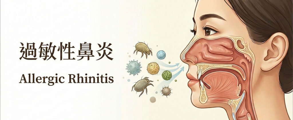 過敏性鼻炎 Banner