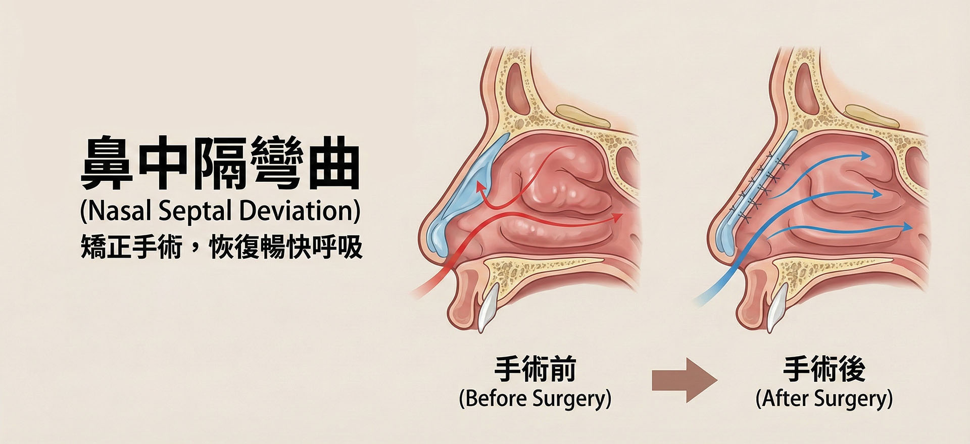 鼻中隔彎曲矯正手術前後對比：氣流阻塞到暢通呼吸示意圖