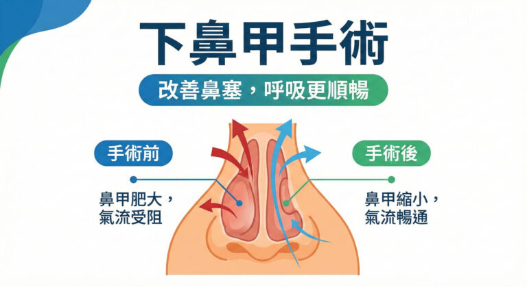下鼻甲手術前後對比:鼻甲肥大鼻塞軎除,呼吸更順暢